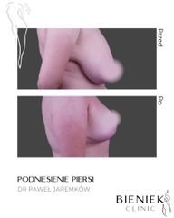 LIFTINGPIERSI_DRPAWELJAREMKOW