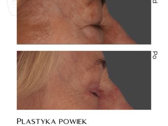 Blefaroplastyka przed i po - 874238