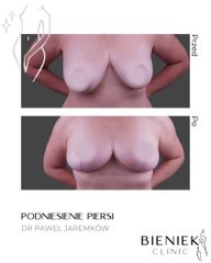 PODNIESIENIEPIERSI_DRPAWEŁJAREMKÓW