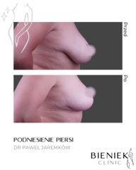 PODNIESIENIEPIERSI2-DRPAWELJAREMKOW