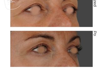 Blefaroplastyka przed i po - 880852