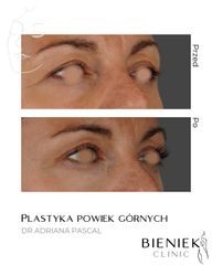 plastyka powiek górnych Dr Adriana Pascal