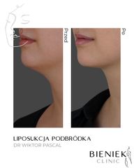 liposukcja podbródka Dr Wiktor Pascal