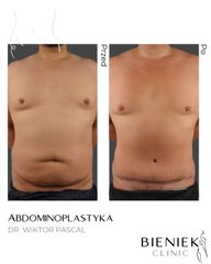 Abdominoplastyka Dr Wiktor Pascal