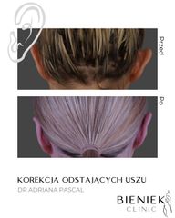 korekcja uszu Dr Adriana Pascal