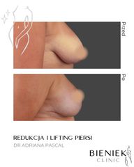 redukcja i lift piersi DR Adriana Pascal