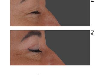 Blefaroplastyka przed i po - 880857
