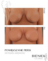 powiększanie piersi Dr Paweł Jaremków