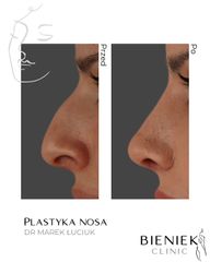 plastyka nosa Dr Marek Łuciuk