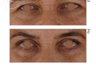 Blefaroplastyka przed i po - 881664