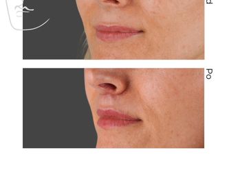 Lip Lift przed i po - 881666