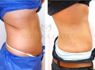 liposukcja_slim_lipo_2