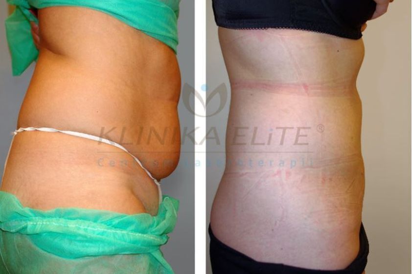 Liposukcja laserowa przed i po - 740131