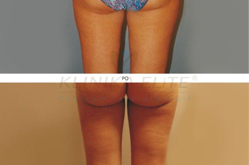 Liposukcja laserowa przed i po - 740144