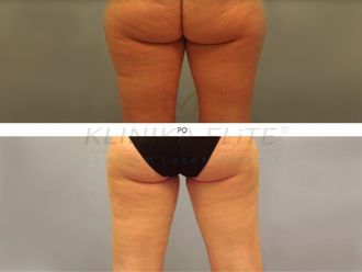 Liposukcja laserowa przed i po - 740146