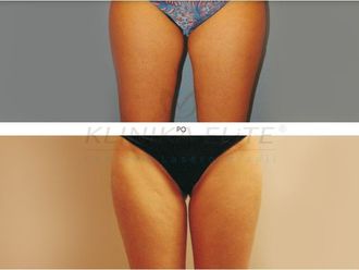 Liposukcja laserowa przed i po - 740147