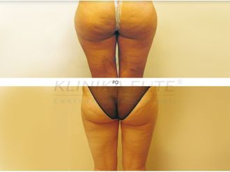Liposukcja laserowa przed i po - 740148