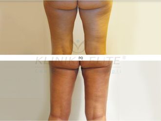 Liposukcja laserowa przed i po - 740150