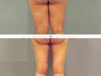 Liposukcja laserowa przed i po - 740151
