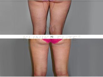 Liposukcja laserowa przed i po - 740152