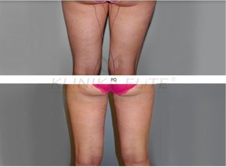 liposukcja_slim_lipo_29