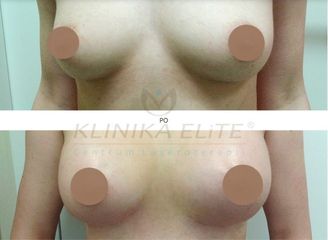 powiekszanie_piersi_implantami_2