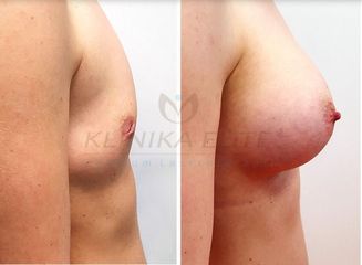 powiekszanie_piersi_implantami_17