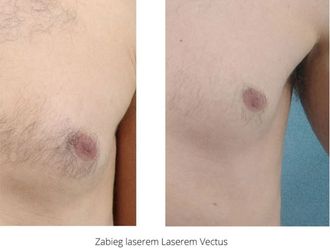 Depilacja laserowa przed i po - 740238