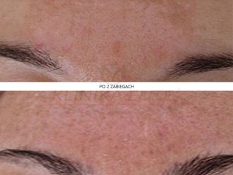 Laserowe zabiegi dermatologii estetycznej przed i po - 740264