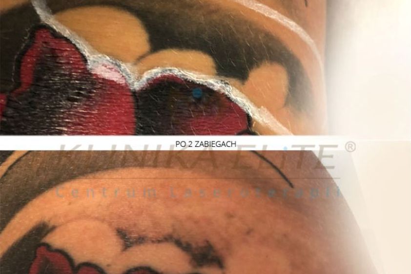 Usuwanie tatuażu przed i po - 740265