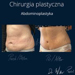 Plastyka brzucha - dr n. med. Wiktor Paskal