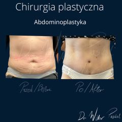 Plastyka brzucha - dr n. med. Wiktor Paskal