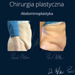 Plastyka brzucha - dr n. med. Wiktor Paskal