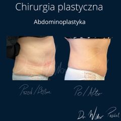 Plastyka brzucha - dr n. med. Wiktor Paskal
