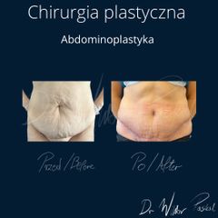 Plastyka brzucha - dr n. med. Wiktor Paskal
