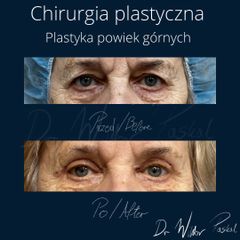 Blefaroplastyka - dr n. med. Wiktor Paskal