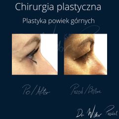 Blefaroplastyka - dr n. med. Wiktor Paskal
