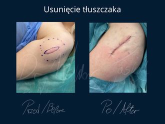 Usuwanie znamion przed i po - 857336