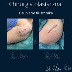 Usuwanie znamion - dr n. med. Wiktor Paskal