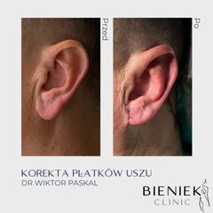 Korekcja uszu - dr n. med. Wiktor Paskal
