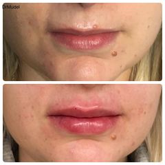 Powiększanie ust - dr Katarzyna Mudel