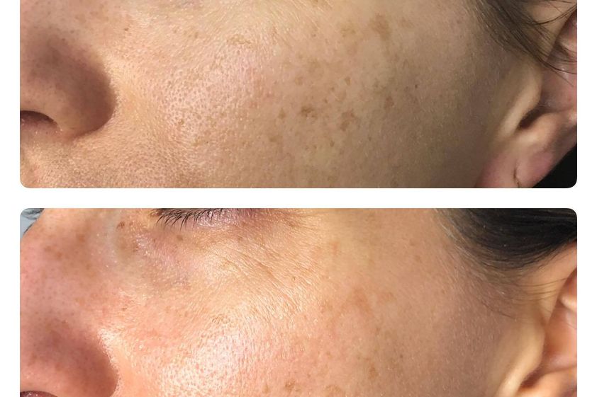 Peeling chemiczny przed i po - 850674