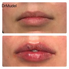 Powiększanie ust - dr Katarzyna Mudel