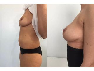 Lipotransfer do piersi - przed i po 