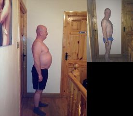 Abdominoplastyka - przed i po