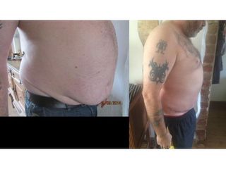 Abdominoplastyka - przed i po