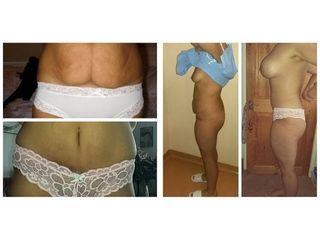 Abdominoplastyka i liposukcja - przed i po