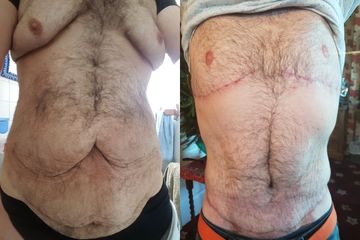 Ginekomastia i luposukcja - przed i po