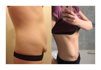 Abdominoplastyka - przed i po