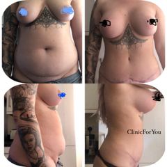 Abdominoplastyka - przed i po